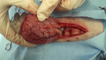 کیا آپ گُردے کی پتھری سے پریشان ہیں