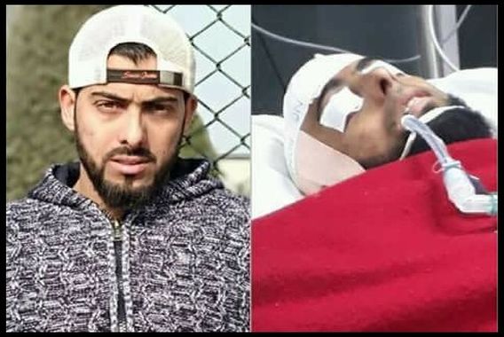 پیلٹ گن کے شکار نوجوان کی حالت نازک